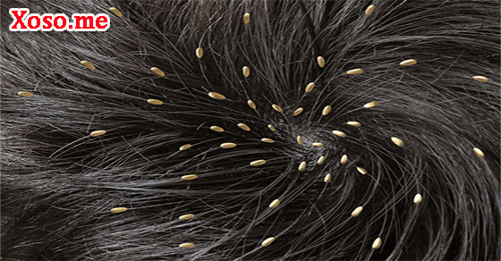 Mơ thấy trứng chấy trên đầu là cảnh báo vấn đề sức khỏe​